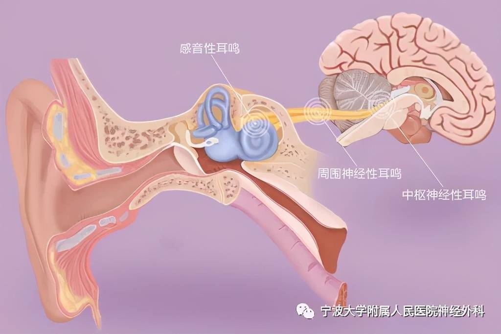 听神经瘤——部分患者听力下降的罪魁祸首