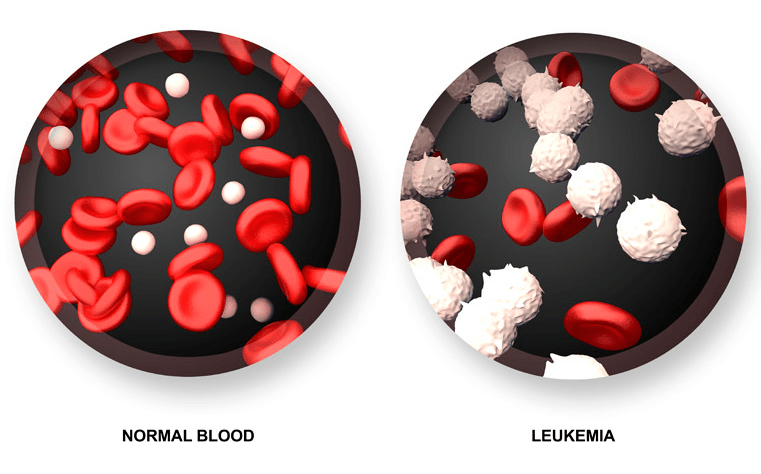 正常血液(左)和白血病血液(右),图源:mountelizabeth