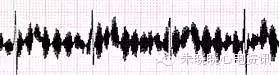其特点为一系列快速而不规则的细小芒刺样波,使心电图波形失真,甚至