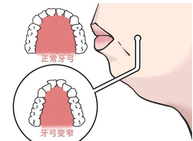 出现牙弓狭窄要怎么办?