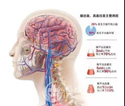 奇迹从世博发生,我院icu成功挽救一名脑干出血患者