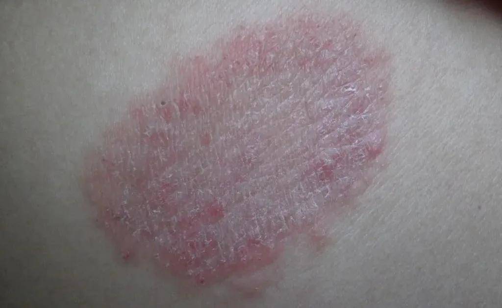 皮肤癣病是浅表皮肤的真菌感染,感染仅局限于皮肤的最外层;通常根据