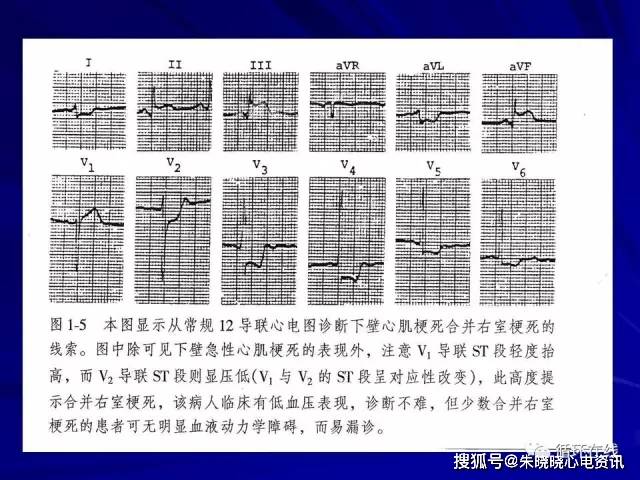 急性冠脉综合征心电图诊断进展