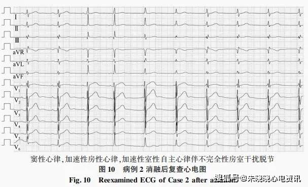 再次消融仍然确定为房颤,左侧希氏束旁室性早搏,室性心动过速,部分伴