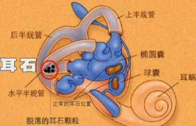 耳石因上述种种原因而脱落,因解剖位置的缘故多沉积于半规管中