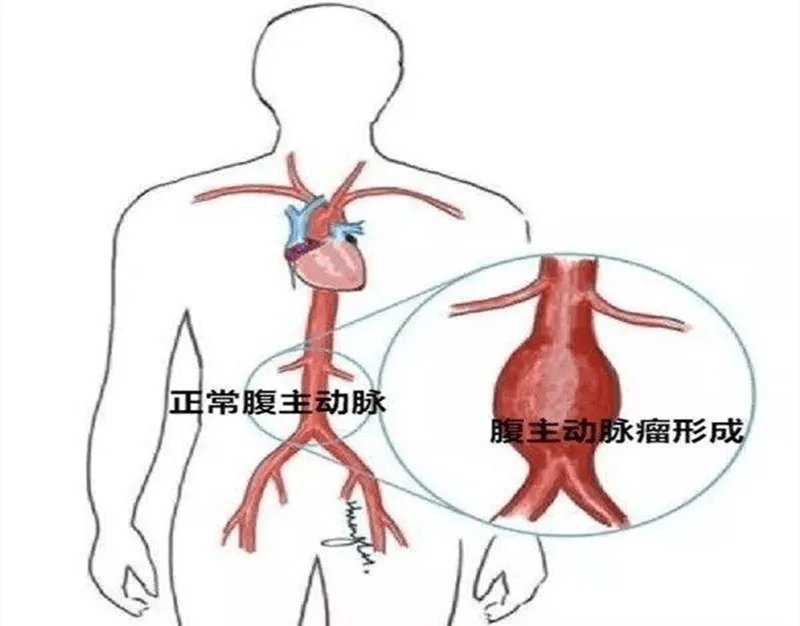 名)在2019年10月被检查出患有腹主动脉瘤,当时除了自觉腹部有搏动感外