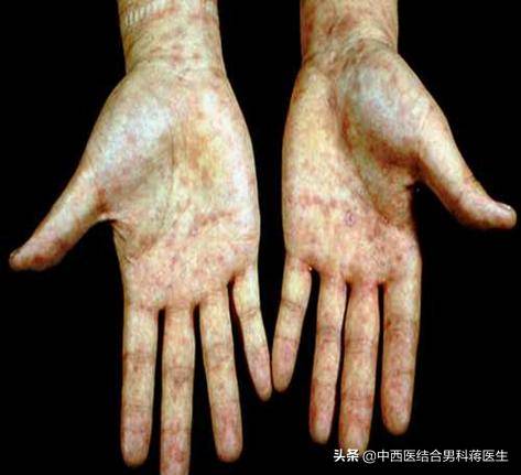 其他:血液,医源性,间接接触 临床表现 一期梅毒:潜伏期2-4周;主要表现