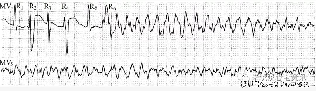 45 心室扑动,心室颤动是最严重的心律失常,心室呈蠕动或不协调的乱颤