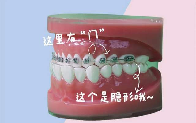 优诺博士正畸|在做矫正前,这个问题要先了解