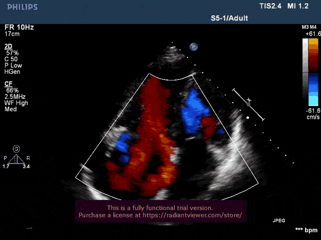 38%(高危).心衰指数bnp2635pg/ml. 术前心超提示 1.