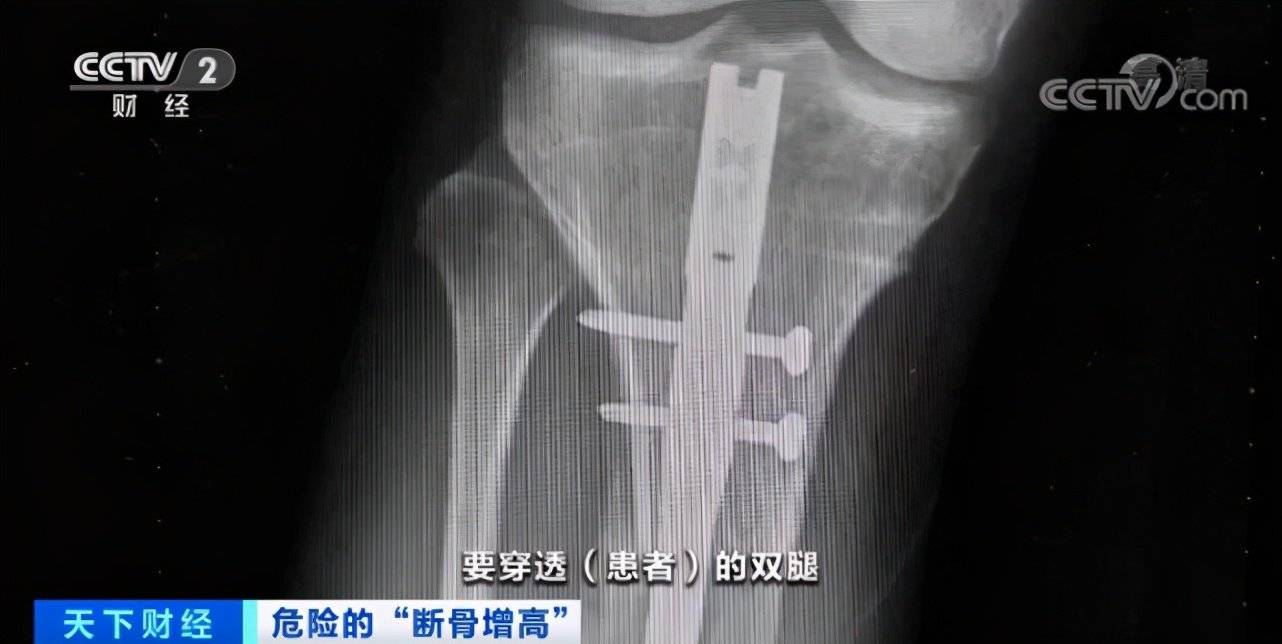男性身高焦虑带火断骨增高手术为了长高几厘米他们宁愿自断双腿