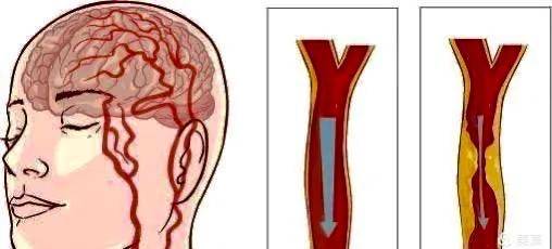 部重度狭窄为了解血管病变的严重程度,给孙先生进行了全脑血管造影术