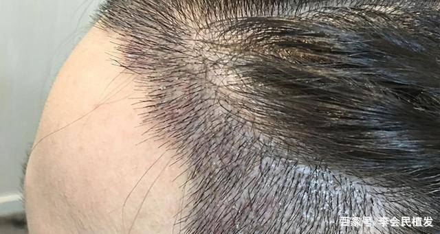 熙朵植发:男性脱发是肾虚?治脱发确定病因是关键