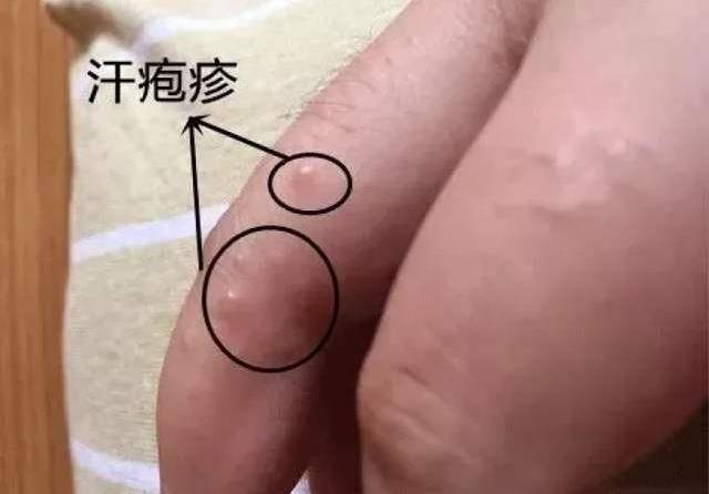 天一热,手上就会出现透明小水泡,莫忽视,可能体内湿气