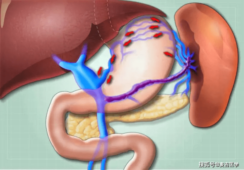 内镜下食管胃底静脉曲张的治疗方法