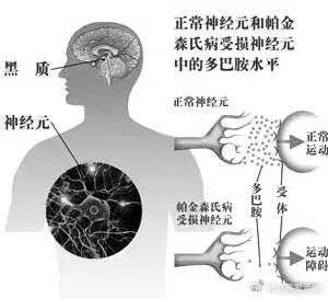 帕金森氏病和帕金森综合征是一个病吗