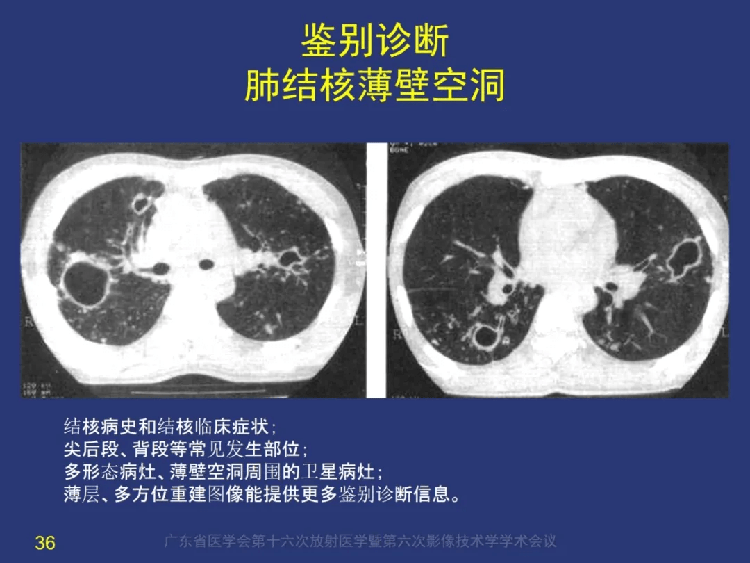 囊腔性肺癌如何诊断空洞性肺癌