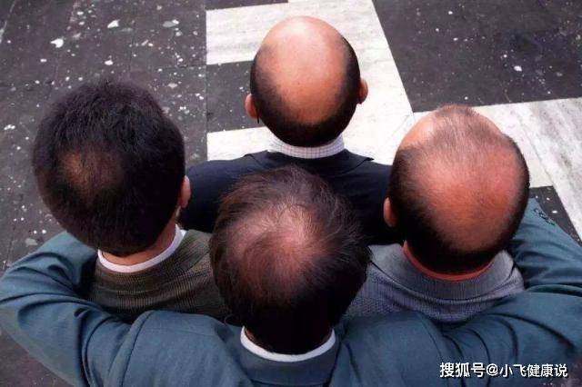 1.肾虚型脱发