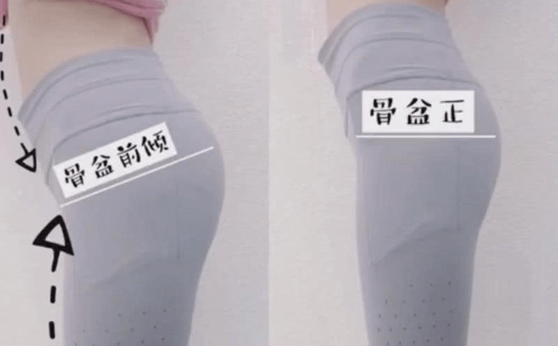 骨盆前倾:3招纠正你的"伪翘臀"!