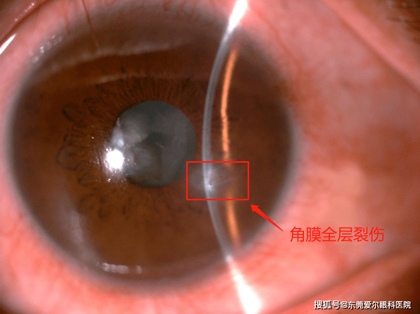 痛钓鱼时鱼钩打到眼睛东莞一男子眼角膜全层裂伤