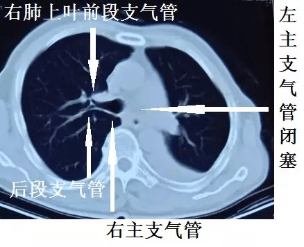 这种"胸水,做胸腔穿刺要出大事!_支气管