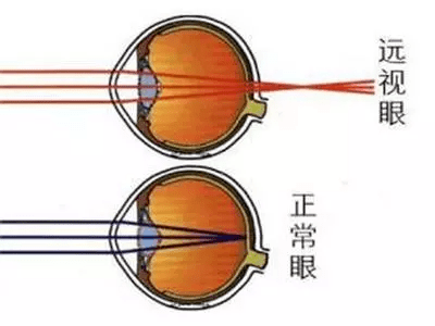 维适科普 关于成年远视,你要了解的在这里