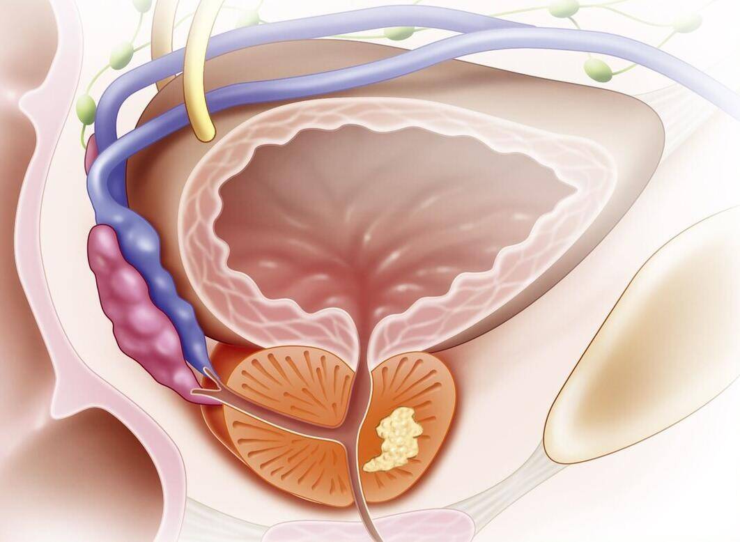 患了前列腺炎还能不能同房?医生:想要同房,记住2个字