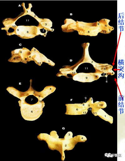 颈椎病解剖经典影像