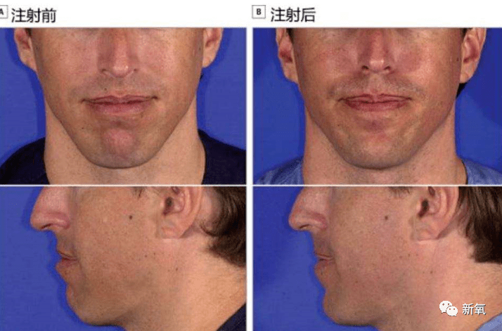 颏肌紧张伴有下巴后缩,也需要先放松颏肌,再注射玻尿酸延长下巴.