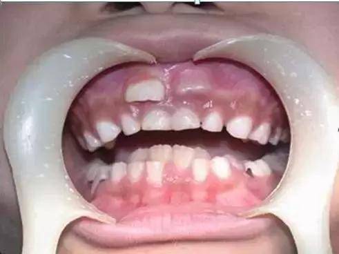 旧的乳牙还在,新长出的牙被挤成倒八字生长,几颗牙齿还向外龇,向里凹