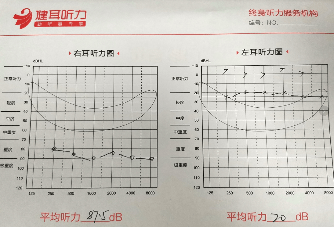 听力损失程度对照表