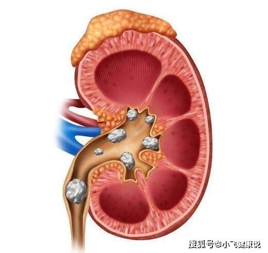 原创易患肾结石的女人不戒掉6个习惯肾里石头可能还会增多