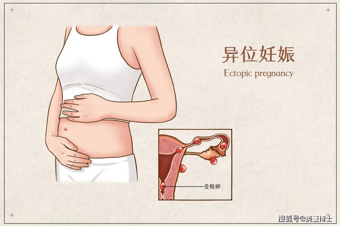 上海第十人民医院戴雪医生:警惕!宫外孕发出的5个信号