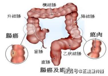 原创放屁多是肠癌?医生告知:出现以下三种症状,或是"肠癌"的信号