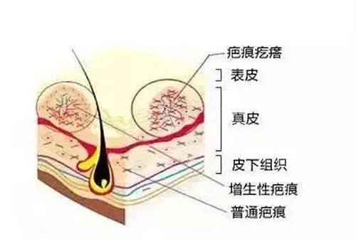 疤痕疙瘩重灾区竟然是胸口?