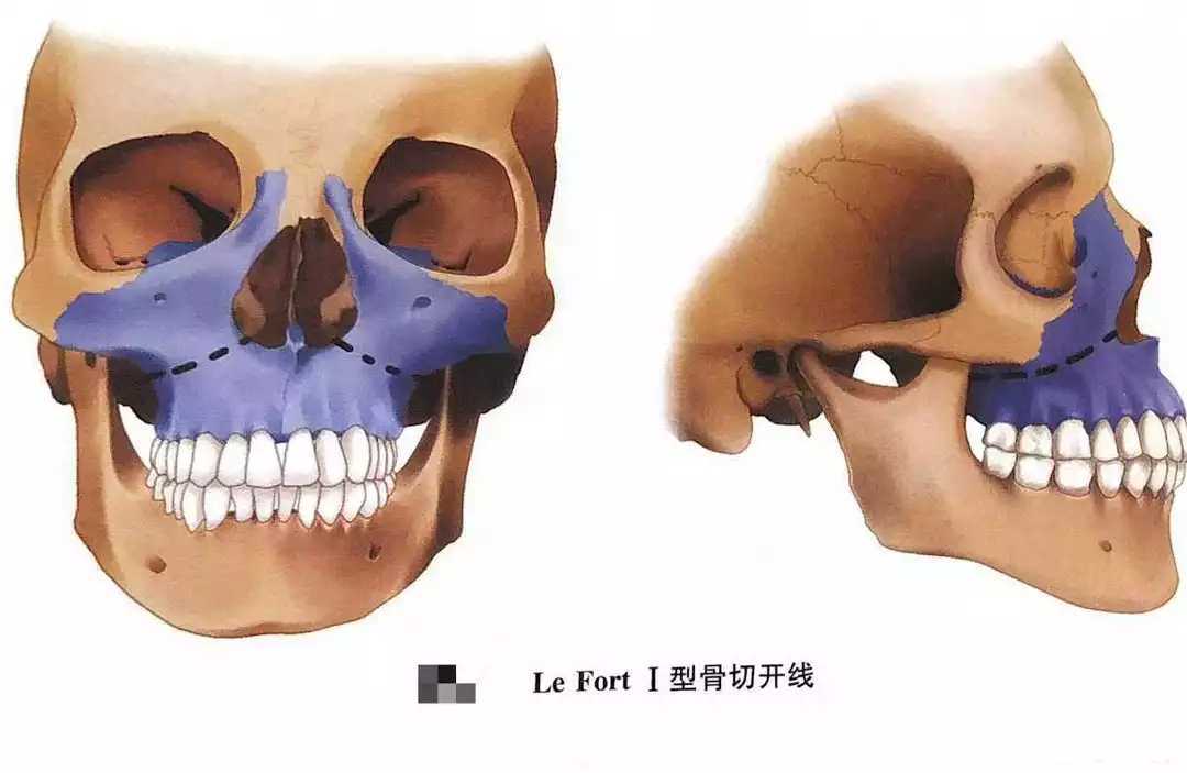 说说lefort1型截gu