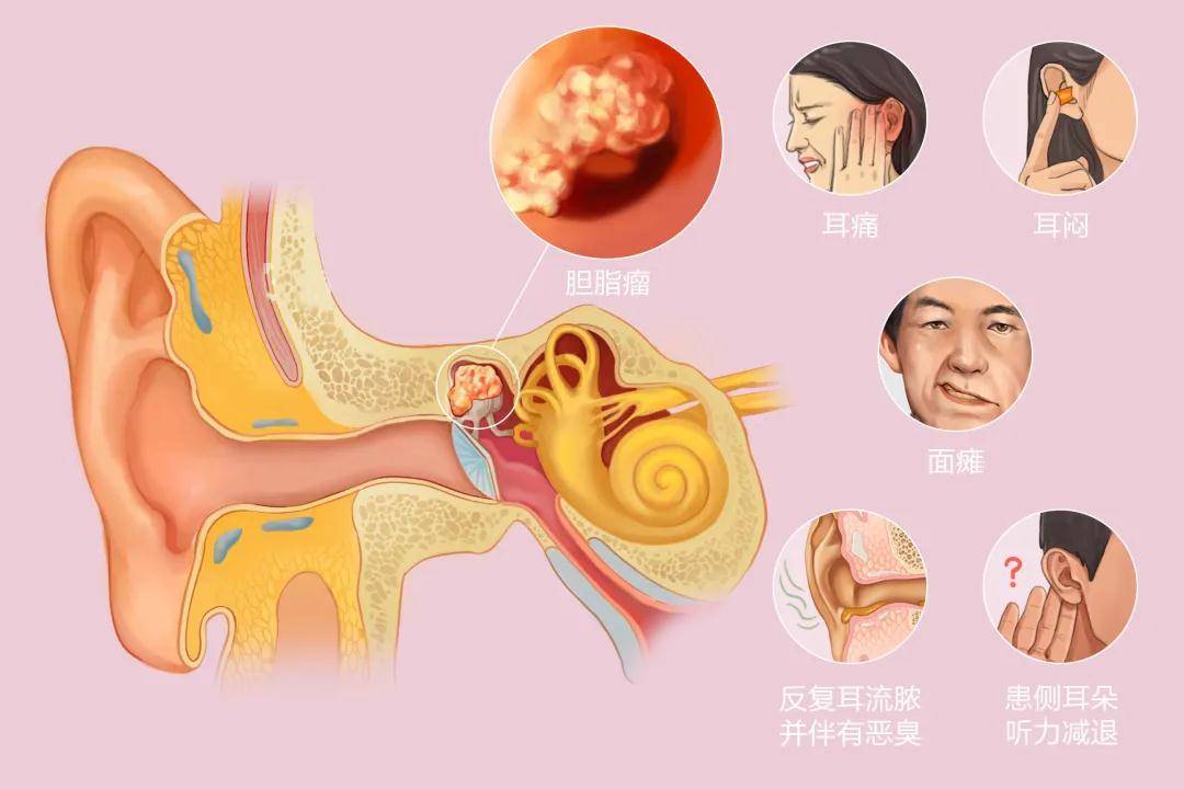 肿瘤,病变部位多在脑部和耳部,可以引起颅内胆脂瘤,外耳道胆脂瘤等