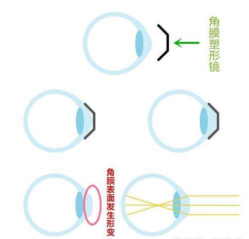 角膜塑形镜是采用一种特殊逆几何形态设计的角膜接触镜,将镜片放置在