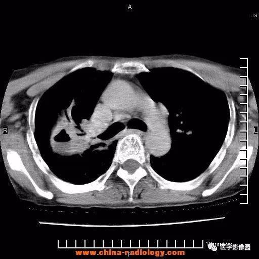 中央型肺癌的ct表现