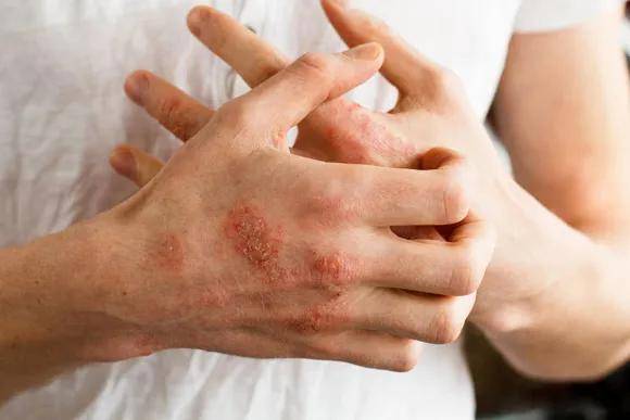 手部皮肤病的种类较多,临床比较常见的有过敏性皮肤病,真菌性皮肤病