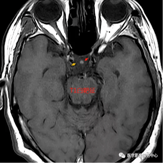 空泡蝶鞍的影像学特点这三个征象要会看