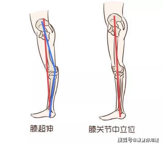 膝超伸是否正常?有没有危害?如何康复?