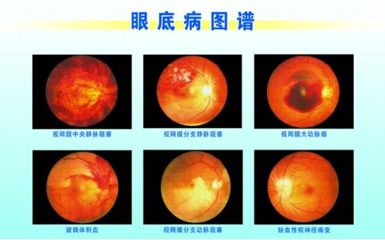 上海眼科医生姚宜:这些症状是患上眼底病的绝对警告,警惕"眼底三患"!