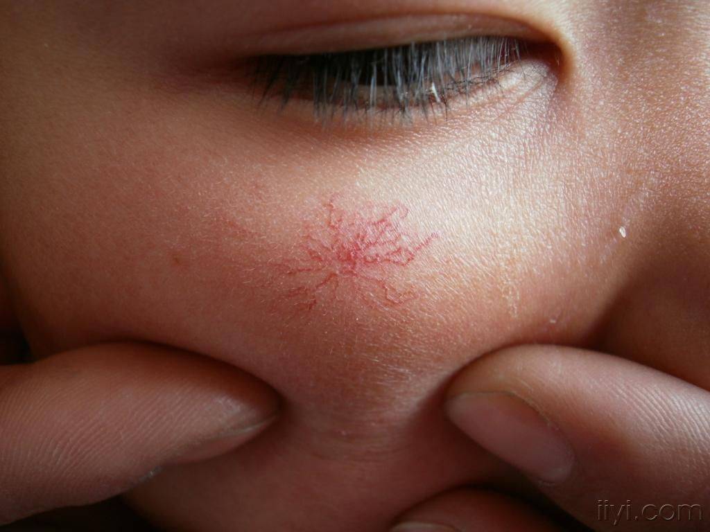 乙肝患者的皮肤容易出现红痣,这是一种血管痣,也被称为种腚痣.