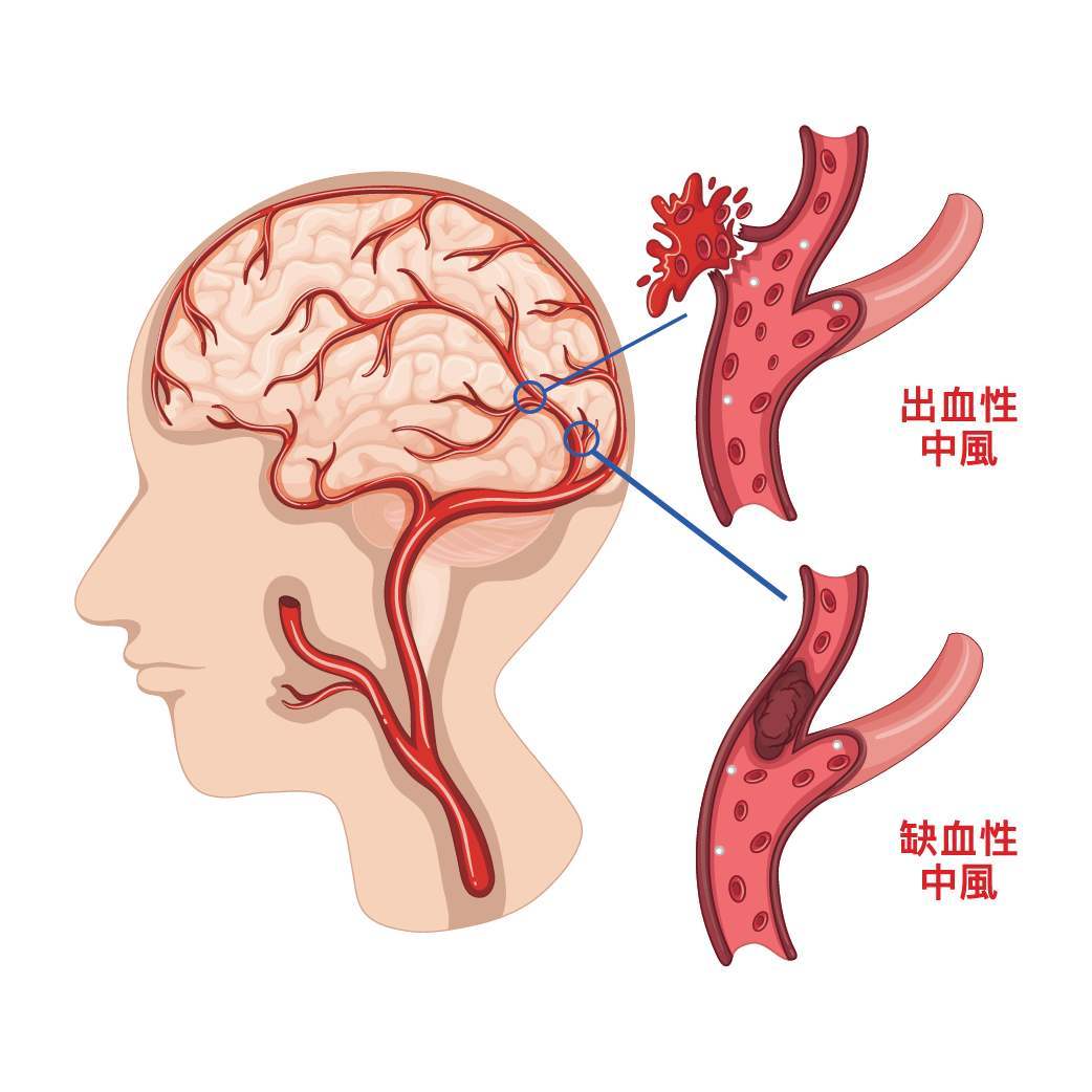 中风后3小时救援黄金期,做到分秒必争无论是大中风,症状轻微的小中风