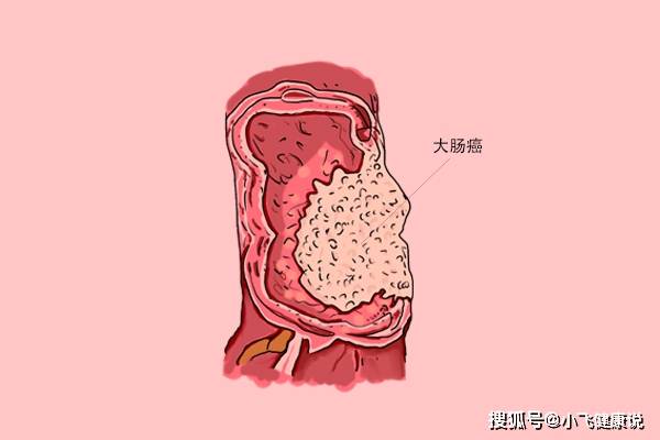 一天发现3例晚期肠癌,医生很痛心,告诉大家:肠癌其实最好预防