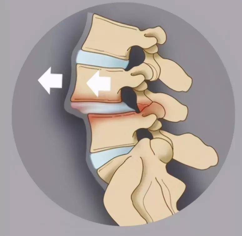 郴州骨科医院提醒:不可忽视的腰痛—腰椎滑脱!
