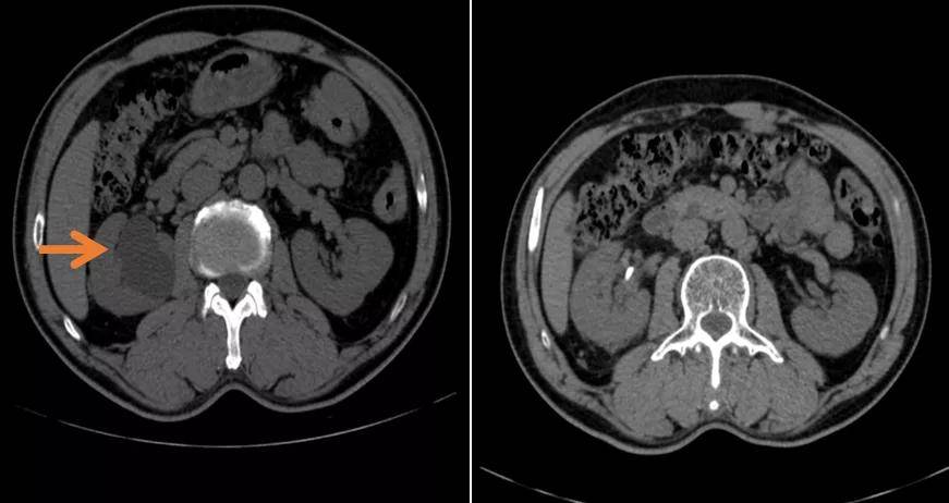 术前ct提示肾盂旁囊肿(左图箭头处);术后ct肾囊肿消失(右图)