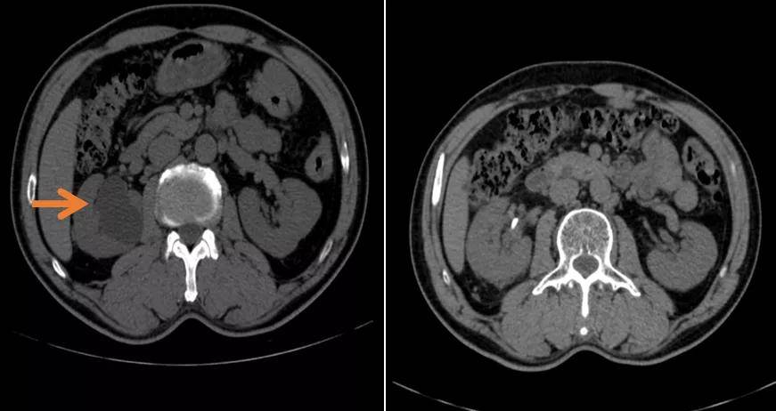 术前ct提示肾盂旁囊肿(左图箭头处;术后ct肾囊肿消失(右图)