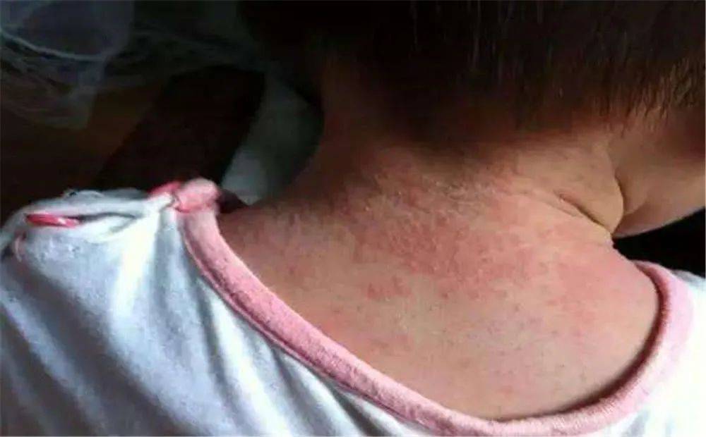 11岁男孩「鱼腥味过敏」致死:孩子出现这5个症状,必须